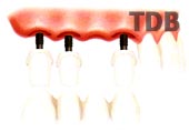 Sostegno in Zirconia Procera, ponte in Zirconia Procera e NobelRondo