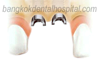 NobelPerfect implant clinique dentaire de Bangkok Thailand
