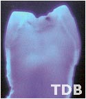 NobelRondo bangkok - natural premolar - reflected and UV-light