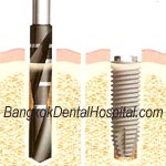 flapless procedure implant bangkok