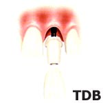 NobelSpeedy, Groovy, Procera Abutment, Procera Crown.