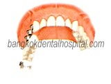 teeth-in-an-hour in dental dental implant thailand