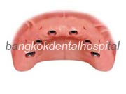 Branemark system Zygoma with NobelGuide Thailand